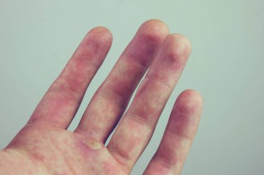 Blister ve Nasırlaşma ile el