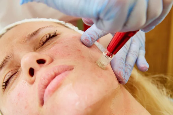 Cuidado de la piel facial. Primer plano de la mujer consiguiendo tratamiento facial de la microdermoabrasión de la hidrodermoabrasión que pela en la clínica cosmética del spa de la belleza. Aspiradora Hydra. Exfoliación, rejuvenecimiento e hidratación. Cosmetología. —  Fotos de Stock