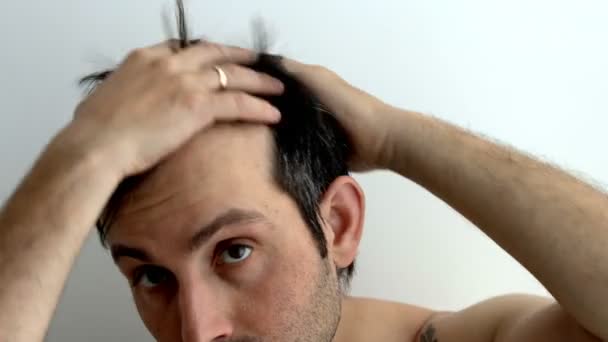 Problema de pérdida de cabello en los hombres. tío extiende el cabello en la cabeza con las manos. — Vídeos de Stock