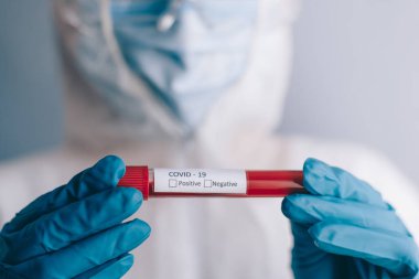 Koronavirüsü test etmek için kan örneğiyle birlikte test tüpü..