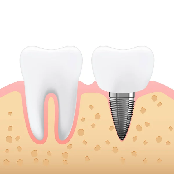 Ilustración esquemática de prótesis dentales, prótesis dentales — Vector de stock