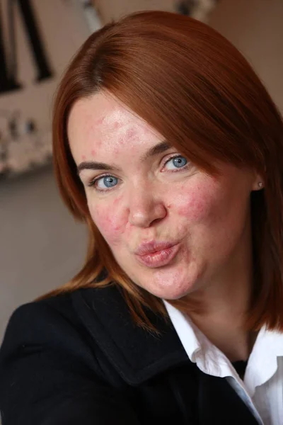 Red haired girl with acne — Stock Photo, Image