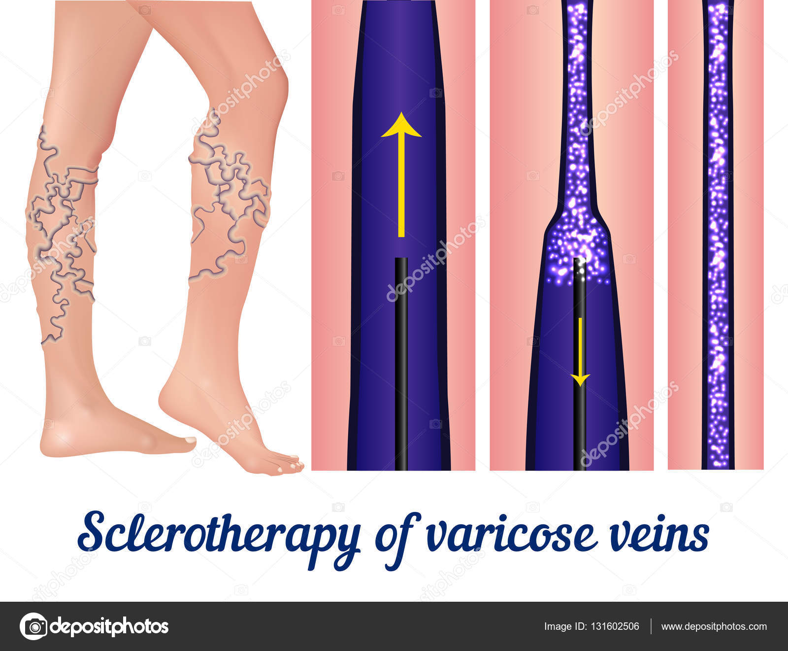 sclerotherapie van aderen prijs