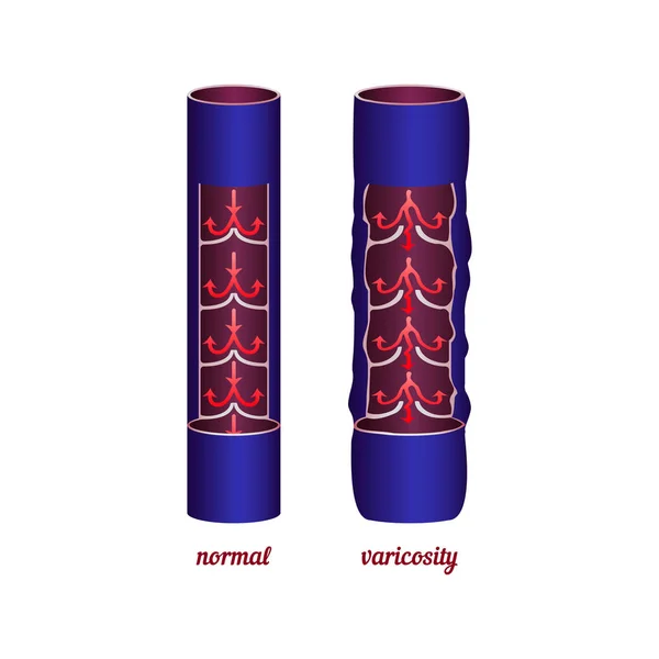 Normal damarlar karşılaştırma ve varis.