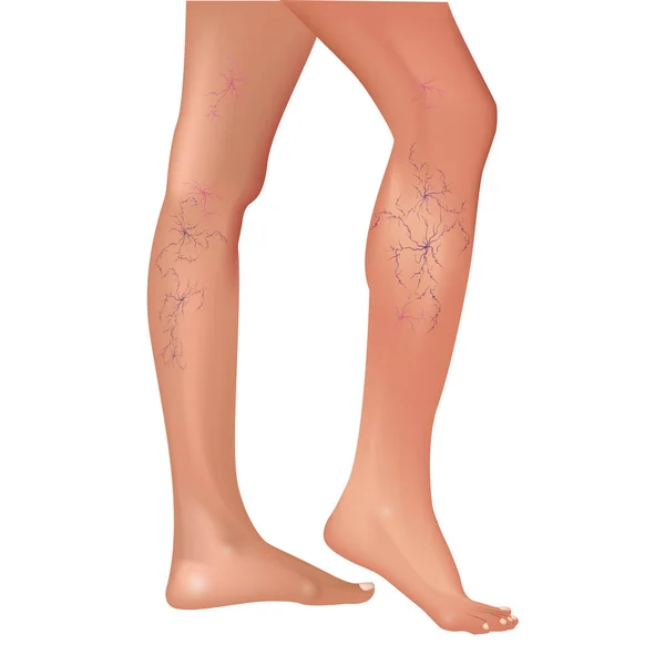 Varicose veins in the legs. Vascular or spider vessels. — Stock Vector