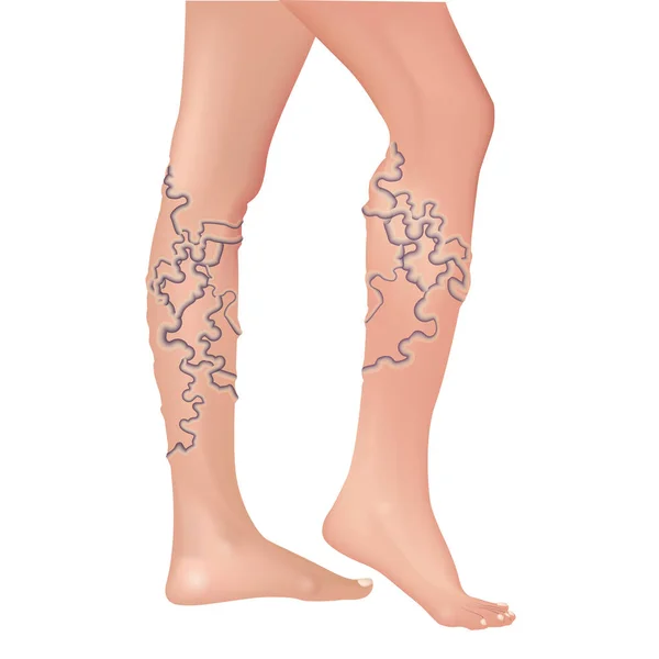 Varicose veins in the legs. — Stock Vector