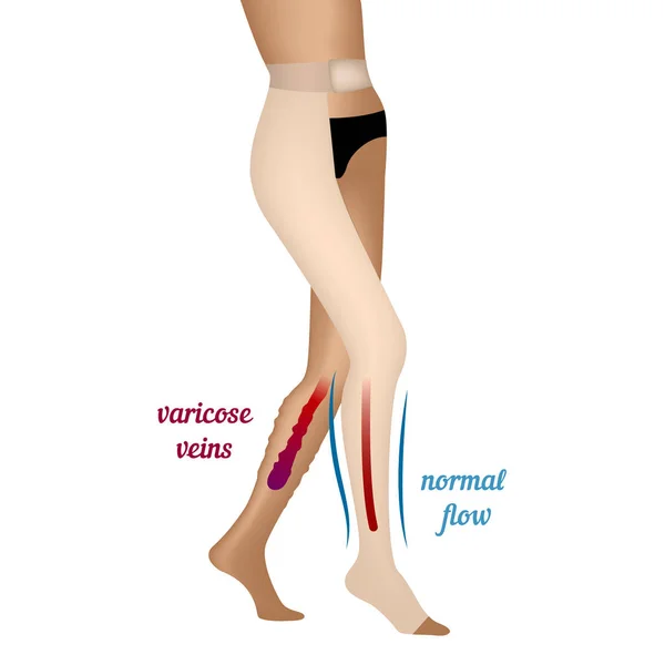 Πλεκτά συμπίεσης για φλεβίτιδα στα πόδια. Κάλτσες για τη βελτίωση της ροής του αίματος. — Διανυσματικό Αρχείο