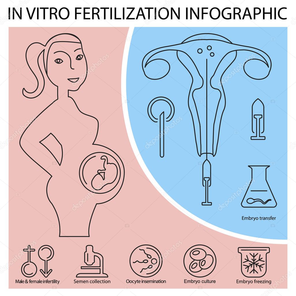 In vitro fertilization infographic