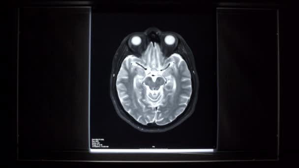 Рентген на панели светильника - Мозг — стоковое видео