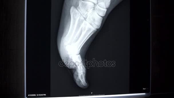 Рентген на панели светильника - Foot Tilt — стоковое видео