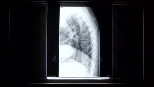 X-ray on illuminator panel - spinal cord — Stock Video