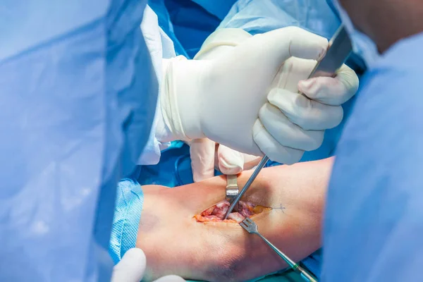 Grupa chirurgów wykonujących operację łokcia — Zdjęcie stockowe