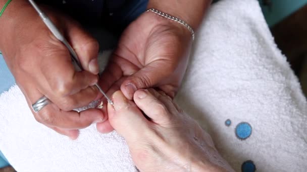 Närbild av en pedikurist ta bort en inåtväxande tånagel Stockvideo
