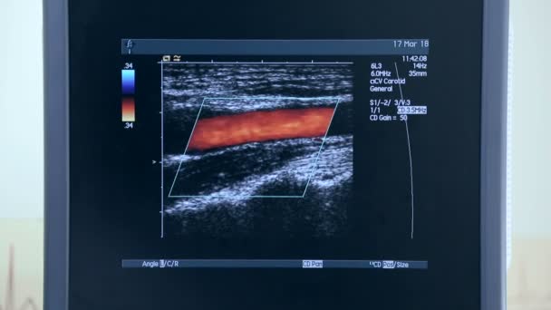 Ultraschallgerät mit Monitor. Untersuchung des Herzens — Stockvideo