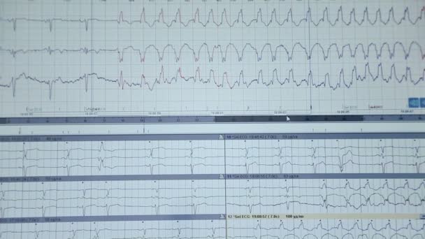 Cardiale hart-en vaatziekten op een close-up van de computer — Stockvideo