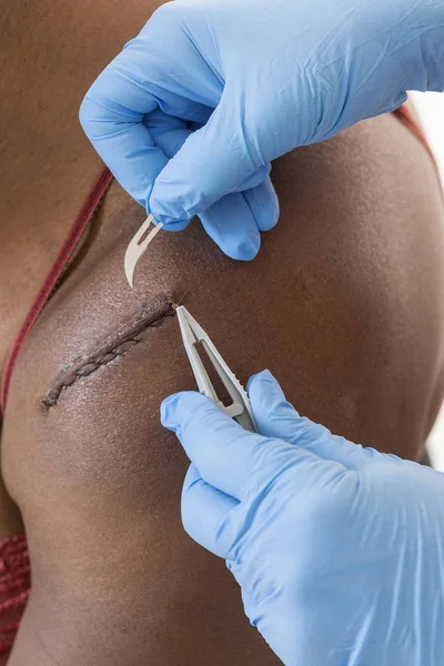 Gloved hands Removing medical thread from wound with stitches on woam blaclk skin shoulder with medical equipment, — Stock Photo, Image