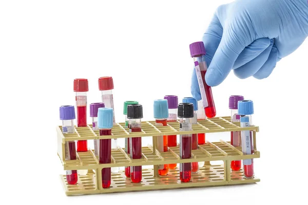 Cientista mão tacking de uma amostra de um rack de tubos de ensaio de bood vista de cima — Fotografia de Stock