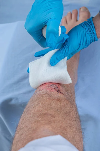 fresh blooded injury wound on the tibial bone of the leg. Sticking stitches to hold the cut.