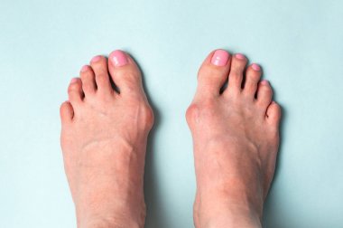 Yaya olarak kemik. Hallux valgus hastalığı
