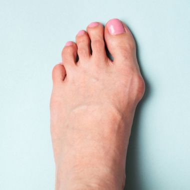 Bunion in foot. Valgus deformation from narrow shoes clipart