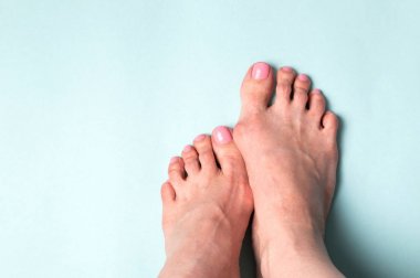 Ortopedik tedavi. Dar ayakkabı valgus deformasyon