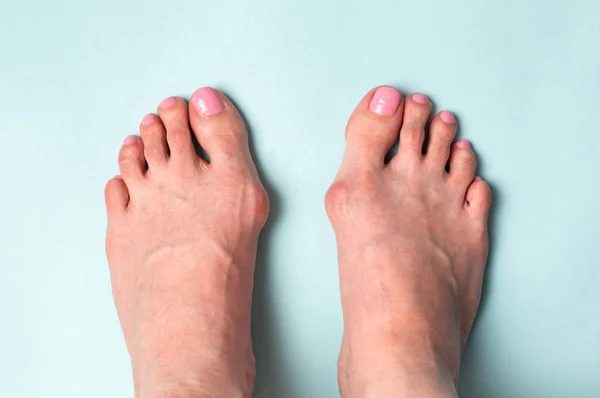 Bone on the foot. Hallux valgus disease — Stock Photo, Image