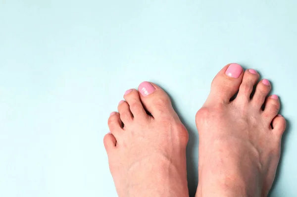 Valgus deformity. Flatfoot. Orthopedic problem and disease — Stock Photo, Image