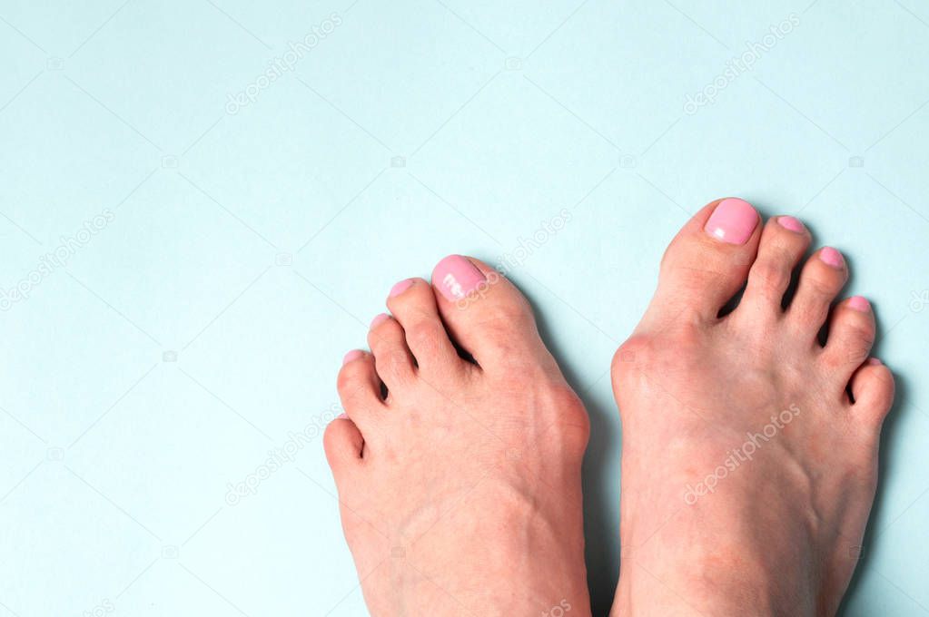 Valgus deformity. Flatfoot. Orthopedic problem and disease