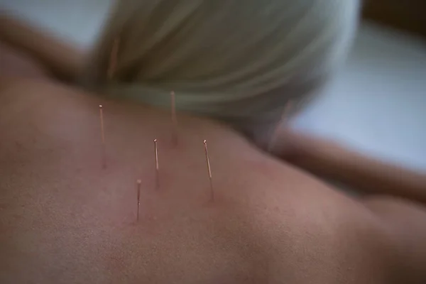 Mujer Joven Recibiendo Tratamiento Acupuntura Sala Terapia Paciente Femenina Sometida — Foto de Stock