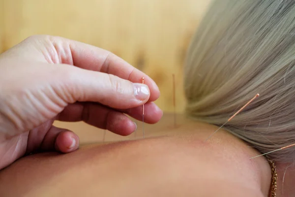 Mujer Joven Recibiendo Tratamiento Acupuntura Sala Terapia Paciente Femenina Sometida — Foto de Stock