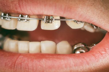 Diş telleri ve derin ısırık için diş cihaz