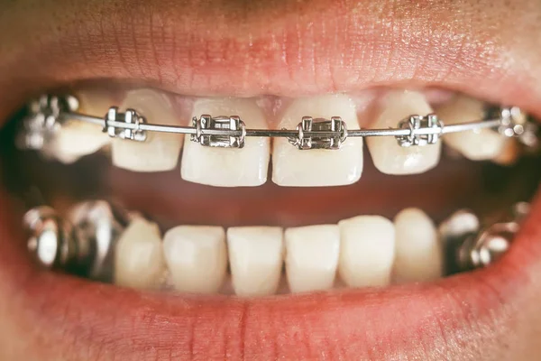 Брекеты Зубной Прибор Глубокого Укуса — стоковое фото