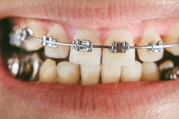 Aparelhos Dentários Para Mordida Profunda — Fotografia de Stock