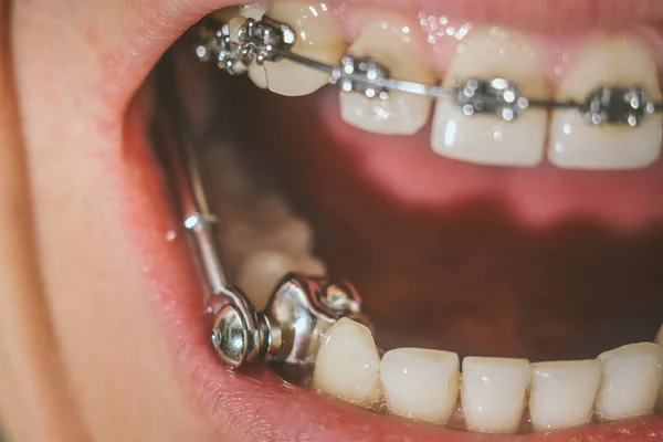 Aparelhos Dentários Para Mordida Profunda — Fotografia de Stock