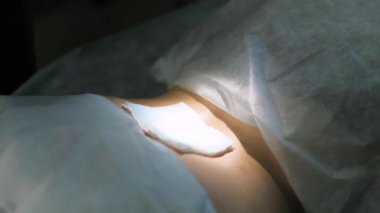 Lazer operatör dövmeler bacak - dövme kaldırma kaldırır.