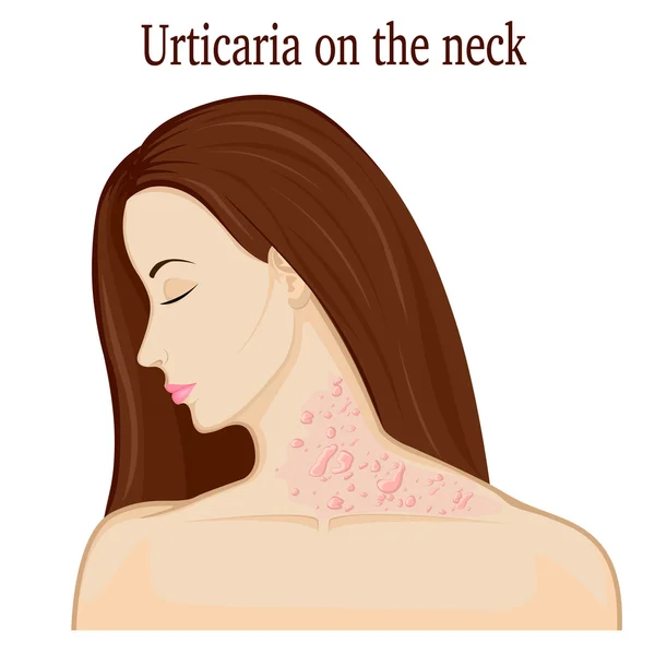 Urticaria en el cuello — Vector de stock