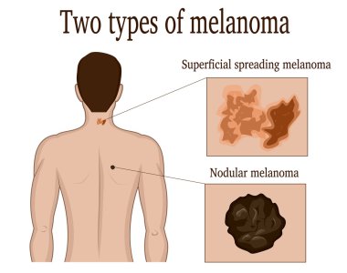 Two types of melanoma clipart