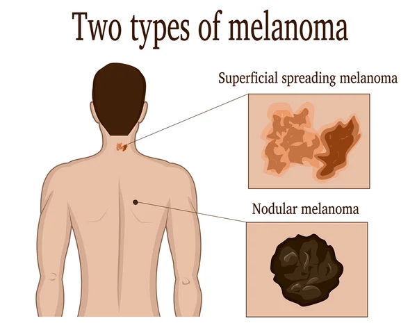 Två typer av melanom — Stock vektor