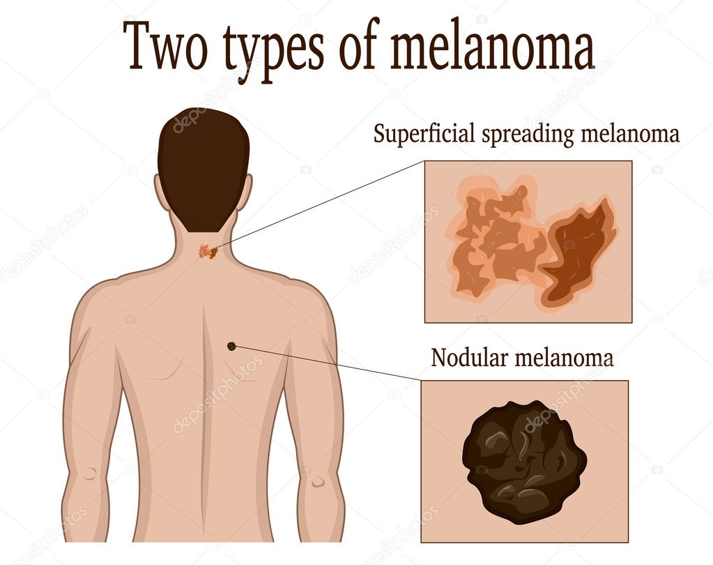 Two types of melanoma