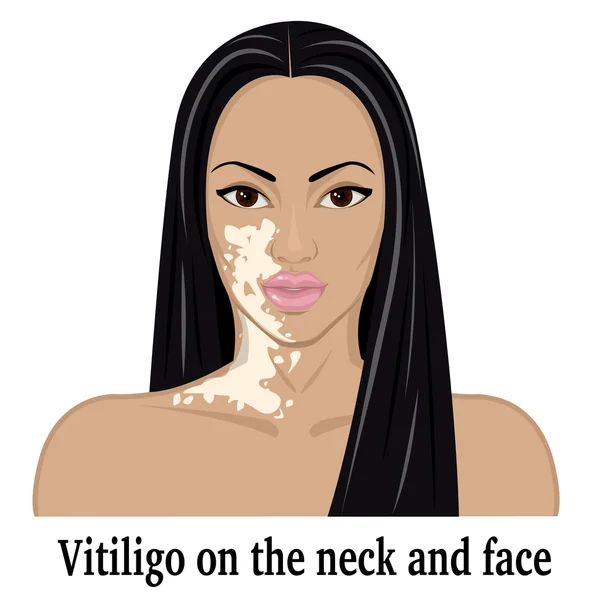 Vitiligo no pescoço e rosto — Vetor de Stock