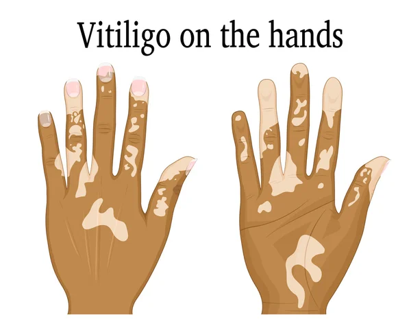 Vitiligo på händerna — Stock vektor