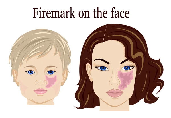 Firemark yüzünde