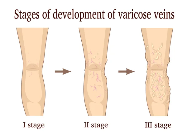 Stages of development of varicose veins — Stock Vector