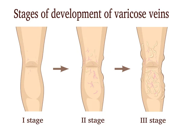 start etapa varicose medicamente varicoză genunchii din spate