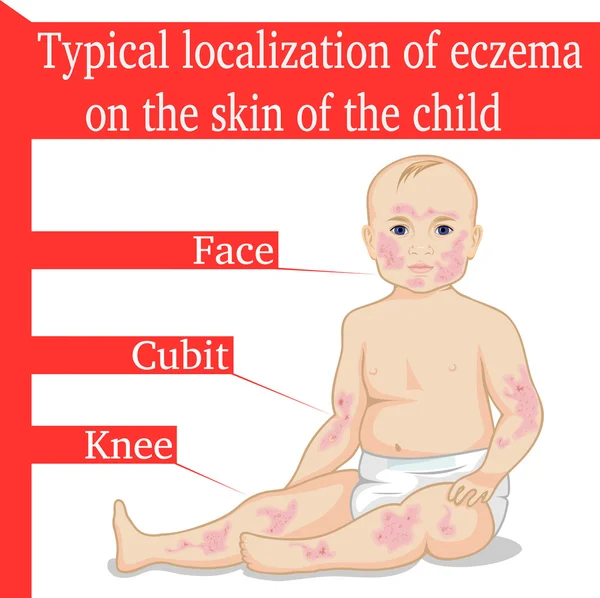 Eczema para uma criança — Vetor de Stock