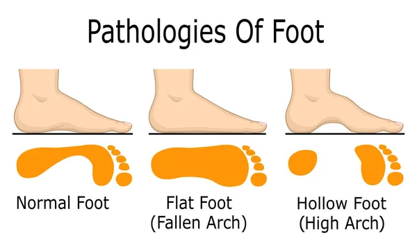 Pathologies of foot — Stock Vector