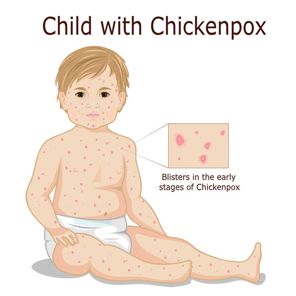 Child with Chickenpox