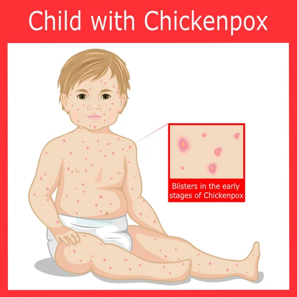 Child with symptoms of Chickenpox — Stock Vector