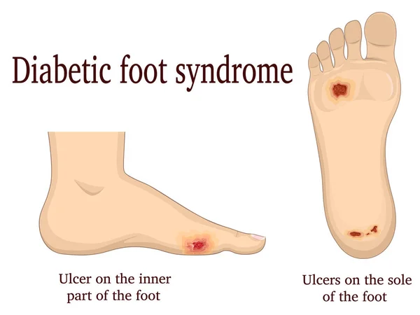 Síndrome do pé diabético —  Vetores de Stock