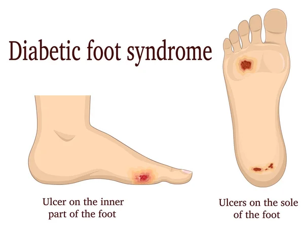 Syndrom diabetické nohy — Stockový vektor